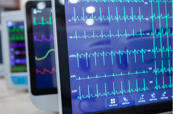 what can ecg detect