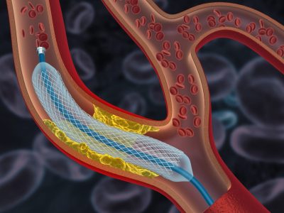 CORONARY ANGIOPLASTY - drkrishnadhoot